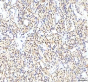 IHC staining of FFPE human lung cancer tissue with PHF6 antibody. HIER: boil tissue sections in pH8 EDTA for 20 min and allow to cool before testing.
