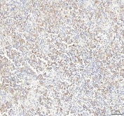 IHC staining of FFPE human testicular seminoma tissue with Phosphoglucomutase 3 antibody. HIER: boil tissue sections in pH8 EDTA for 20 min and allow to cool before testing.