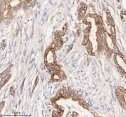 HER4 Antibody Rabbit Polyclonal Pancreas Ductal Adenocarcinoma IHC. Immunohistochemistry of HER4 antibody in human pancreas ductal adenocarcinoma tissue. FFPE human pancreatic ductal adenocarcinoma sections were subjected to heat-induced epitope retrieval by boiling in pH 8 EDTA for 20 minutes followed by cooling prior to staining. The rabbit polyclonal HER4 antibody was used as the detecting antibody. HRP-DAB brown staining is observed predominantly along the membranous and cytoplasmic compartments of malignant ductal epithelial cells, while surrounding stromal elements show comparatively lower background staining. The staining pattern is consistent with Erb-B2 receptor tyrosine kinase 4 expression in pancreatic carcinoma tissue.