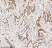 HER4 Antibody Pancreas Ductal Adenocarcinoma IHC. Immunohistochemistry staining of FFPE human pancreas ductal adenocarcinoma tissue with HER4 antibody. HIER: boil tissue sections in pH8 EDTA for 20 min and allow to cool before testing.