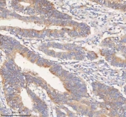 HER4 Antibody Colon Adenocarcinoma IHC. Immunohistochemistry of HER4 antibody in human colon adenocarcinoma tissue. FFPE human colon adenocarcinoma sections were subjected to heat-induced epitope retrieval by boiling in pH 8 EDTA for 20 minutes followed by cooling prior to staining. The rabbit polyclonal HER4 antibody was used as the detecting antibody. HRP-DAB brown staining is observed predominantly in the membranous and cytoplasmic compartments of malignant glandular epithelial cells, while adjacent stromal elements display comparatively lower background staining. The staining pattern is consistent with Erb-B2 receptor tyrosine kinase 4 expression in colon adenocarcinoma tissue.