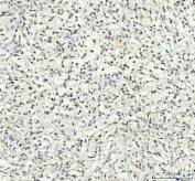 Phospho-AKT1 (pT450) Antibody Lymphoma Tissue IHC. Immunohistochemistry of FFPE human intestinal diffuse large B-cell lymphoma tissue using phospho-AKT1 (pT450) antibody shows HRP-DAB brown cytoplasmic and nuclear staining in malignant lymphoid cells, consistent with activated PI3K-AKT signaling and phosphorylation at the T450 turn motif, while surrounding stromal elements display lower background; clone HEA-1 was used for detection. HIER: boil tissue sections in pH8 EDTA for 20 min and allow to cool before testing.