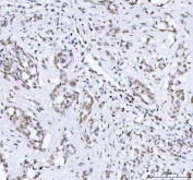 Phospho-AKT1 (pT450) Antibody Lung Adenocarcinoma IHC. Immunohistochemistry of FFPE human lung adenocarcinoma tissue using phospho-AKT1 (pT450) antibody demonstrates HRP-DAB brown cytoplasmic and nuclear staining in tumor epithelial cells, consistent with phosphorylation-dependent AKT1 activation within PI3K-AKT signaling, while stromal regions show comparatively reduced staining; detection was performed with clone HEA-1. HIER: boil tissue sections in pH8 EDTA for 20 min and allow to cool before testing.