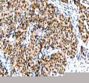 IHC staining of FFPE human lung cancer tissue with IPO9 antibody. HIER: boil tissue sections in pH8 EDTA for 20 min and allow to cool before testing.
