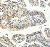 IHC staining of FFPE human colorectal adenocarcinoma tissue with JNK1 antibody. HIER: boil tissue sections in pH8 EDTA for 20 min and allow to cool before testing.