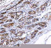 IHC staining of FFPE human gastric adenocarcinoma tissue with PGC antibody. HIER: boil tissue sections in pH8 EDTA for 20 min and allow to cool before testing.