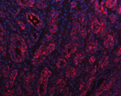 Immunofluorescent staining of FFPE human gastric cancer tissue with PGC antibody (red) and DAPI nuclear stain (blue). HIER: steam section in pH8 EDTA buffer for 20 min.