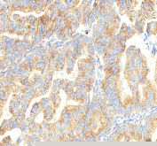 IHC staining of FFPE human ovarian cancer tissue with PCDHB14 antibody. HIER: boil tissue sections in pH8 EDTA for 20 min and allow to cool before testing.