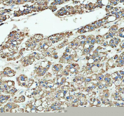 IHC staining of FFPE human liver cancer tissue with ARHGEF12 antibody, HRP-labeled secondary and DAB substrate. HIER: boil tissue sections in pH8 EDTA for 20 min and allow to cool before testing.