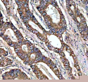 IHC staining of FFPE human stomach cancer tissue with AqCbl reductase antibody, HRP-labeled secondary and DAB substrate. HIER: boil tissue sections in pH8 EDTA for 20 min and allow to cool before testing.