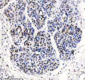 TARDBP Antibody Pancreatic Cancer IHC. Immunohistochemistry analysis of FFPE human pancreatic cancer tissue stained with anti-TARDBP antibody. Following heat-induced epitope retrieval in pH 8 EDTA buffer, strong HRP-DAB brown nuclear staining is observed in tumor cells, consistent with the known nuclear localization of TAR DNA-binding protein 43 / TDP-43, an RNA-binding protein involved in RNA processing, stress granule regulation, and post-transcriptional gene expression pathways.