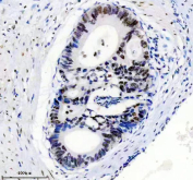 TARDBP Antibody Stomach Cancer IHC. Immunohistochemistry analysis of FFPE human stomach cancer tissue stained with anti-TARDBP antibody. Following heat-induced epitope retrieval in pH 8 EDTA buffer, strong HRP-DAB brown nuclear staining is observed in malignant epithelial cells, consistent with the known nuclear-associated expression pattern of TAR DNA-binding protein 43 / TDP-43, an RNA-binding protein involved in RNA splicing, mRNA regulation, and stress-responsive RNA metabolism pathways.
