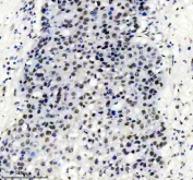 TARDBP Antibody Liver Cancer IHC. Immunohistochemistry analysis of FFPE human liver cancer tissue stained with anti-TARDBP antibody. Following heat-induced epitope retrieval in pH 8 EDTA buffer, strong HRP-DAB brown nuclear staining is observed throughout malignant cell populations, consistent with the known nuclear localization of TAR DNA-binding protein 43 / TDP-43, an RNA-binding protein involved in RNA splicing, mRNA stability, and stress-responsive RNA regulatory pathways.