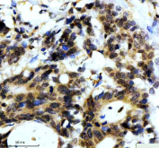 IHC staining of FFPE human colon cancer tissue with Alpha-Synuclein antibody, HRP-secondary and DAB substrate. HIER: boil tissue sections in pH8 EDTA for 20 min and allow to cool before testing.