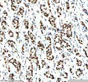 IHC staining of FFPE human breast cancer tissue with Cyclin dependent kinase 9 antibody, HRP-secondary and DAB substrate. HIER: boil tissue sections in pH8 EDTA for 20 min and allow to cool before testing.