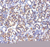 IHC staining of FFPE human thyroid cancer tissue with GABARAPL2 antibody, HRP-secondary and DAB substrate. HIER: boil tissue sections in pH8 EDTA for 20 min and allow to cool before testing.