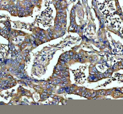 IHC staining of FFPE human colon cancer tissue with CAMK2 antibody, HRP-secondary and DAB substrate. HIER: boil tissue sections in pH8 EDTA for 20 min and allow to cool before testing.