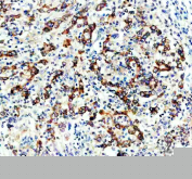 DGAT1 Antibody Human Stomach Cancer IHC. IHC staining of FFPE human stomach cancer tissue with DGAT1 antibody revealed strong cytoplasmic and membranous staining in malignant epithelial cells, consistent with the role of DGAT1 (Diacylglycerol O-Acyltransferase 1) in triglyceride synthesis and lipid droplet formation. DGAT1 is a key regulator of neutral lipid metabolism and has been implicated in metabolic adaptation and tumor cell survival. The widespread staining pattern observed in tumor cells is consistent with increased lipid biosynthesis and energy storage requirements associated with cancer progression. Staining was performed using an HRP-conjugated secondary antibody and DAB chromogen. Heat-induced epitope retrieval was achieved by boiling tissue sections in pH 8 EDTA buffer for 20 minutes followed by cooling before immunostaining.