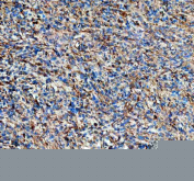 IHC staining of FFPE human glioma tissue with NES antibody, HRP-secondary and DAB substrate. HIER: boil tissue sections in pH8 EDTA for 20 min and allow to cool before testing.