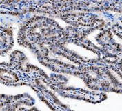 IHC staining of FFPE human ovarian cancer tissue with DEAD box protein 1 antibody, HRP-secondary and DAB substrate. HIER: boil tissue sections in pH8 EDTA for 20 min and allow to cool before testing.