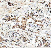 IHC staining of FFPE human breast cancer tissue with USP5 antibody, HRP-secondary and DAB substrate. HIER: boil tissue sections in pH8 EDTA for 20 min and allow to cool before testing.