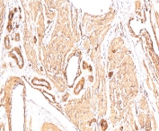 IHC: FFPE human leiomyosarcoma stained with Smooth Muscle Actin antibody (clone 1A4).