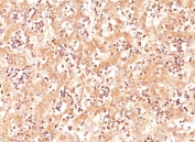AFP Antibody Human Fetal Liver Tissue IHC. Immunohistochemistry testing of human fetal liver stained with AFP antibody (clone C3).