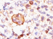 Bcl-X Antibody Hodgkin's Lymphoma IHC. Immunohistochemistry staining of Hodgkin's lymphoma tissue using Bcl-X Antibody (clone BX006) demonstrates cytoplasmic and membranous HRP-DAB brown staining within neoplastic cells. The staining pattern is consistent with expression of Bcl-X family proteins, including the anti-apoptotic isoform Bcl-XL, which functions to promote cellular survival through inhibition of mitochondrial apoptosis pathways. Bcl-X proteins are important regulators of programmed cell death and have been extensively studied in hematologic malignancies due to their roles in apoptosis resistance, tumor cell persistence, and therapeutic response. The observed cytoplasmic and membrane-associated staining supports expression of Bcl-X in lymphoma-associated cellular populations.