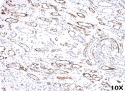 Immunohistochemistry analysis of C4d antibody (clone C4D204) in human kidney transplant tissue at 10X magnification. Formalin-fixed, paraffin-embedded renal tissue demonstrates linear and circumferential HRP-DAB brown staining along peritubular capillaries and small vascular structures, consistent with C4d deposition within capillary walls. Glomerular and tubular epithelial nuclei are hematoxylin counterstained and largely negative. The staining pattern highlights microvascular structures within the transplant tissue, while background staining is minimal.