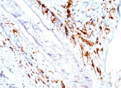 CD1A Antibody for IHC. Immunohistochemistry analysis of CD1A / CD1a expression in human skin tissue using CD1A Antibody. Membranous and cytoplasmic staining is observed in dendritic cells within the epidermis and superficial dermis, consistent with Langerhans cell localization, while surrounding keratinocytes remain largely negative. Increased density and clustering of CD1a-positive cells at the epithelial interface supports involvement of antigen-presenting dendritic cells in local inflammatory responses and immune activation within skin.