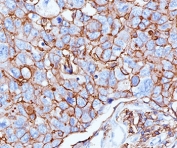 HCAM Antibody Breast Cancer IHC. Immunohistochemistry analysis of HCAM / CD44 expression in FFPE human breast cancer tissue using mouse monoclonal antibody clone 156-3C11. Membranous HRP-DAB brown staining is observed in tumor epithelial cells, outlining cell borders and highlighting cell surface localization consistent with HCAM/CD44 expression. The staining pattern demonstrates heterogeneous intensity across tumor cells and supports its use for evaluating HCAM/CD44 distribution, tumor cell organization, and microenvironment-associated expression in breast carcinoma tissue. Heat induced epitope retrieval was performed by boiling tissue sections in pH 9 10mM Tris with 1mM EDTA for 20 min followed by cooling at RT before testing.