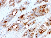 IHC testing of FFPE human colon carcinoma stained with CEA antibody (clone CEA31).