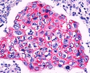 Beta-Catenin Antibody Breast Ductal Carcinoma IHC. Immunohistochemistry of formalin/paraffin breast ductal carcinoma stained with beta-Catenin antibody. Note membrane staining in ductal carcinoma.