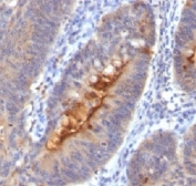 Secretory Component Antibody Colon Carcinoma IHC. Immunohistochemistry testing of human colon carcinoma and Secretory Component antibody (clone SC05).