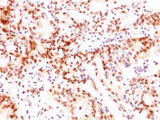 Estrogen Receptor beta Antibody Ovarian Cancer Tissue IHC. Immunohistochemistry of FFPE human ovarian carcinoma tissue using Estrogen Receptor beta antibody shows HRP-DAB brown nuclear staining in tumor epithelial cells, consistent with ESR2 expression in hormone-responsive ovarian cancer, while surrounding stromal regions display lower background; detection was performed with clone ERb455.