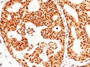 Estrogen Receptor beta Antibody Breast Cancer Tissue IHC. Immunohistochemistry of FFPE human breast carcinoma tissue using Estrogen Receptor beta antibody shows HRP-DAB brown nuclear staining in tumor epithelial cells, consistent with ESR2 expression in hormone-responsive breast cancer, while surrounding stromal elements display lower background; detection was performed with clone ERb455.