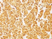 MART-1 Antibody Clone M2-7C10 Human Melanoma Tissue Immunohistochemistry. IHC testing of FFPE human melanoma stained with MART-1 antibody (clone M2-7C10). Note cytoplasmic staining of cells. HIER: boil tissue sections in pH 9 10mM Tris with 1mM EDTA for 10-20 min.