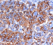 Melan-A Antibody Clone A103 Melanoma IHC. Immunohistochemistry analysis of FFPE human melanoma tissue stained with clone A103. Strong cytoplasmic and membranous HRP-DAB brown staining is observed throughout malignant melanocytic tumor cells, consistent with the expected expression pattern of Melan-A / MLANA/MART-1 in melanoma-associated differentiation and melanosome-related cellular pathways.