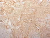 Fibronectin Antibody Clone HFN7.1 Pancreatic Adenocarcinoma IHC. Immunohistochemistry staining of FFPE human pancreatic adenocarcinoma tissue with Fibronectin antibody (clone HFN7.1), HRP-secondary and DAB substrate. HIER: boil tissue sections in pH 9 10mM Tris with 1mM EDTA for 20 min and allow to cool before testing.