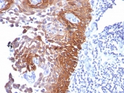 Cytokeratin 17 Antibody Clone E3 immunohistochemistry analysis of human cervical carcinoma tissue. Immunohistochemistry of FFPE human cervical carcinoma demonstrates strong HRP-DAB brown cytoplasmic and membranous staining in tumor epithelial cells using Cytokeratin 17 Antibody Clone E3. The staining highlights malignant epithelial cells consistent with the known expression of Cytokeratin 17 (CK17 / KRT17), an epithelial intermediate filament protein frequently detected in stratified epithelial tissues and epithelial tumors. Adjacent stromal and inflammatory cells are largely negative, supporting epithelial cell specificity of the staining pattern. Heat-induced epitope retrieval was performed by boiling tissue sections in 10 mM Tris buffer (pH 9) containing 1 mM EDTA for 10-20 minutes followed by cooling at room temperature prior to antibody incubation.