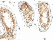 ODC-1 Antibody Testicular Carcinoma IHC. Formalin/paraffin human testicular carcinoma stained with ODC-1 antibody (clone ODC1/485).