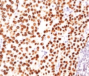 Progesterone Receptor Antibody Clone PR484 immunohistochemistry analysis in human breast carcinoma. FFPE human breast carcinoma tissue was stained with the mouse monoclonal Progesterone Receptor Antibody Clone PR484 following heat induced epitope retrieval by boiling sections in pH 9 10mM Tris with 1mM EDTA for 10-20 minutes and cooling at room temperature for 20 minutes prior to staining. HRP-DAB brown chromogenic signal reveals strong nuclear staining in tumor epithelial cells, consistent with the nuclear localization of Progesterone receptor (PGR) in hormone-responsive breast carcinoma tissue.