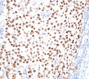 Progesterone Receptor Antibody Clone PR500 immunohistochemistry analysis in human breast carcinoma. FFPE human breast carcinoma tissue was stained with the mouse monoclonal Progesterone Receptor Antibody Clone PR500 following heat induced epitope retrieval by boiling tissue sections in 10mM citrate buffer (pH 6.0) for 10-20 minutes and cooling at room temperature for 20 minutes prior to staining. HRP-DAB brown chromogenic signal reveals strong nuclear staining in tumor epithelial cells, consistent with the nuclear localization of Progesterone receptor (PGR) in hormone-responsive breast carcinoma tissue.
