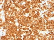 IHC staining of human melanoma with Gp100 Antibody Clone HMB45. HIER: boil tissue sections in pH 9 10mM Tris with 1mM EDTA for 20 min and allow to cool before testing.