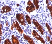 Thyroglobulin Antibody Clone 2H11. Immunohistochemistry analysis of Thyroglobulin using Thyroglobulin Antibody Clone 2H11 in FFPE human thyroid tissue section. HRP-DAB brown chromogenic staining highlights strong cytoplasmic signal in thyroid follicular epithelial cells forming thyroid follicles, with additional staining of luminal colloid material. The staining pattern is characteristic of Thyroglobulin expression in differentiated thyroid follicular epithelium and reflects its role as a marker of thyroid follicular cell differentiation.