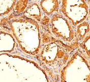 Thyroglobulin Antibody / TG Thyroid Tumor Marker Antibody. Immunohistochemistry analysis of Thyroglobulin using Thyroglobulin antibody (clone 6E1) in FFPE human thyroid tissue section. HRP-DAB brown chromogenic staining highlights strong cytoplasmic signal in thyroid follicular epithelial cells forming well defined follicular structures, with prominent staining of luminal colloid material reflecting abundant secreted Thyroglobulin. The staining pattern supports the use of Thyroglobulin as a thyroid tumor marker and marker of thyroid follicular epithelial differentiation, commonly used to identify thyroid-derived tumors and evaluate thyroid carcinoma biology.
