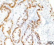 TTF-1 Antibody Clone 8G7G3/1 Lung Adenocarcinoma IHC. Human lung adenocarcinoma stained using TTF-1 Antibody Clone 8G7G3/1 demonstrates strong nuclear immunoreactivity for Thyroid transcription factor 1 (NKX2-1) in malignant pulmonary epithelial cells. Nuclear staining highlights tumor cells of pulmonary epithelial origin and reflects the well-established use of clone 8G7G3/1 antibody as a diagnostic immunohistochemistry marker for pulmonary adenocarcinoma. TTF-1 expression in tumor cell nuclei assists pathologists in identifying lung adenocarcinoma and distinguishing primary pulmonary carcinoma from metastatic tumors involving the lung.