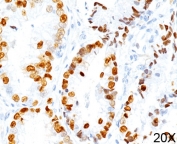 TTF-1 Antibody Clone 8G7G3/1 Human Lung Adenocarcinoma Tissue IHC. Human lung adenocarcinoma stained using TTF-1 Antibody Clone 8G7G3/1 shows strong nuclear staining for Thyroid transcription factor 1 (NKX2-1) in malignant pulmonary epithelial cells. Nuclear immunoreactivity highlights pulmonary epithelial tumor cells and reflects the diagnostic role of clone 8G7G3/1 antibody in immunohistochemistry panels used for lung adenocarcinoma evaluation. Detection of nuclear NKX2-1 expression supports pulmonary epithelial lineage and helps distinguish primary lung carcinoma from metastatic malignancies.