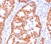 p53 Antibody Clone BP53-12 / TP53 Tumor Suppressor Antibody. Immunohistochemistry analysis of FFPE human colon carcinoma tissue demonstrates strong nuclear staining of tumor epithelial cells using p53 Antibody Clone BP53-12. The HRP-DAB brown chromogenic signal highlights nuclear localization of Tumor protein p53 within malignant epithelial cells, while surrounding stromal and non-neoplastic cells show comparatively weaker staining. The staining pattern is consistent with nuclear accumulation of TP53 commonly observed in colorectal carcinoma.