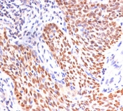 p40 Antibody IHC. Immunohistochemistry analysis of FFPE human lung squamous cell carcinoma tissue demonstrates strong HRP-DAB brown nuclear staining in tumor cell populations, while surrounding stromal cells remain largely negative. The nuclear-restricted staining pattern highlights epithelial cells with basal-like characteristics and supports use of this antibody as a basal progenitor cell maintenance marker, reflecting deltaNp63-driven transcriptional programs associated with proliferative epithelial compartments. Staining is intense and well-defined, allowing clear distinction between p40-positive tumor regions and adjacent negative tissue. Heat-induced epitope retrieval was performed using pH 9 10mM Tris with 1mM EDTA buffer.
